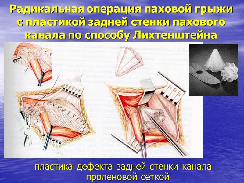 Радикальная операция паховой грыжи с пластикой задней стенки пахового канала по способу Лихтенштейна 